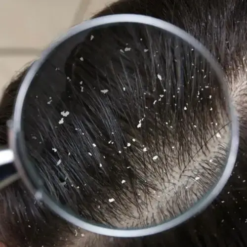 Dandruff